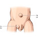 Mengenali Tanda dan Gejala Hernia Pada Bayi